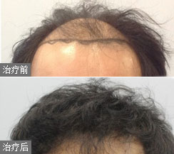 田先生的植发再修复