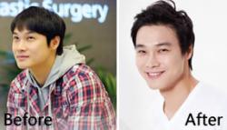 韩国多娜医院为男性患者植发解决脱发问题