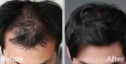 毛发移植中心男性头发加密手术案例