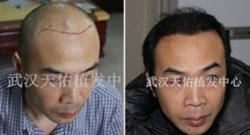 医院植发中心治疗脂溢性脱发5级案例