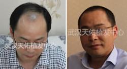 武汉天佑植发中心无痛无痕植发手术案例