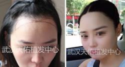 武汉天佑植发中心对女性先天性发际线高施术效果