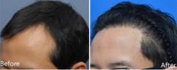 韩国theblack植发男性发际线前后对比案例