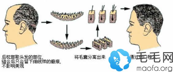 FUT植发手术的示意图