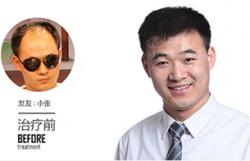 昆明碧莲盛植发案例 男性植发手术治疗脱发
