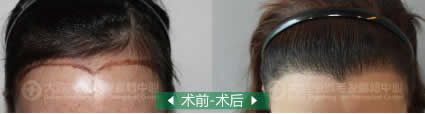 大连京城植发中心案例 女性选择植发治疗遗传性脱发