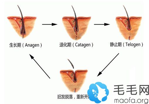 DHT侵害毛囊导致脱发