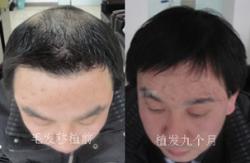 石家庄友谊医院植发案例 术后九个月效果