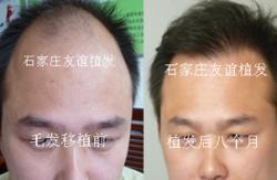 石家庄友谊植发案例 男性脂溢性脱发治疗效果