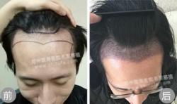 郑州陇海毛发移植案例 前额脱发治疗效果
