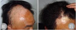 太原显微手外科医院疤痕种植的常见病历