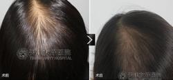 天津友好医院植发案例 女性头发加密手术