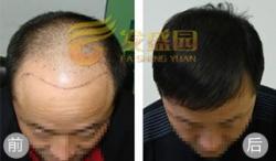 北京发盛园植发案例 六级脱发患者成功植发