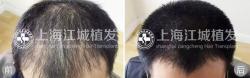 医院植发案例 头发稀疏选择植发