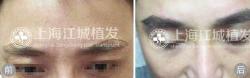 医院植发案例 男性种植眉毛效果