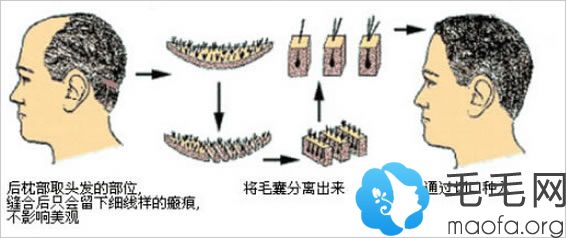 植发的两种方法无痕植发和有痕植发