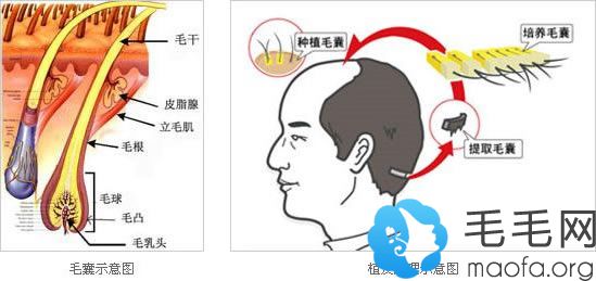 严重脱发了做植发手术靠谱吗