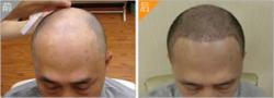 太原丽都植发案例 植发手术解决秃顶烦恼
