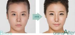 韩国高兰得发际线案例 3D立体发际线移植术