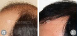 杭州格莱美植发案例 植发治疗前额头顶大面积脱发
