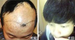 重庆重生疤痕植发案例 4D-CCS无痕植发治疗脱发