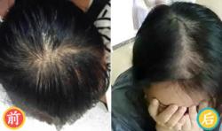 武汉久生生植发案例