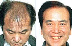 石家庄博士园植发案例 植发治疗男性秃顶手术
