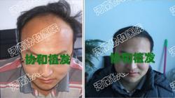 医院为李先生种植头发案例