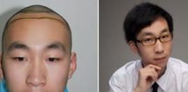 植发没有效果是什么原因？多长时间达到稳定效果？