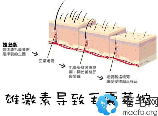 雄激素导致毛囊萎缩图