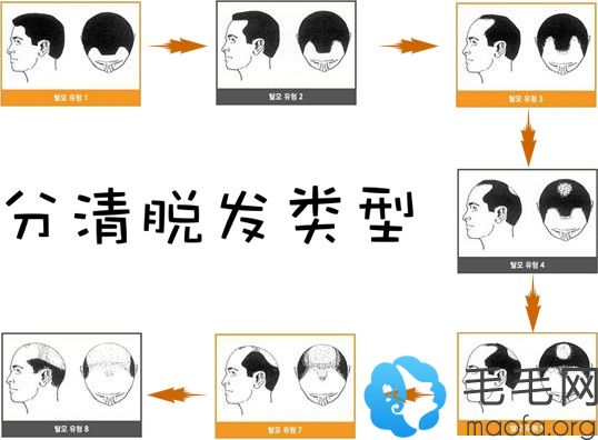 治疗脱发首先要分清脱发类型