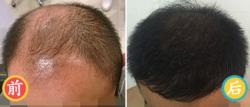 济南碧莲盛植发案例 男性6级脱发植发效果