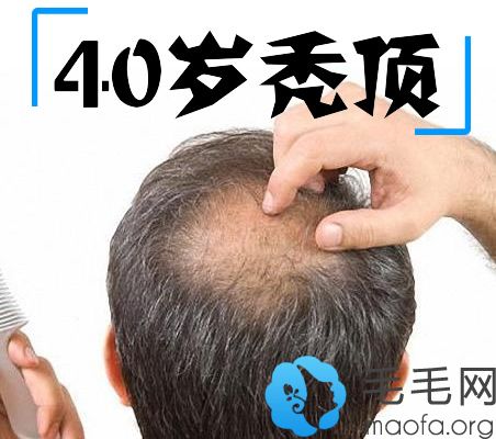 为什么男人到了40岁容易脱发呢？