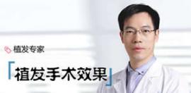 碧盛蓮植發(fā)醫(yī)生袁國安總結植發(fā)手術的未來效果