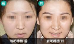 重庆迪邦植眉真实案例 眉毛稀拉加密植发效果