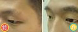 北医三院植眉真实案例 男性眉毛缺损种植效果