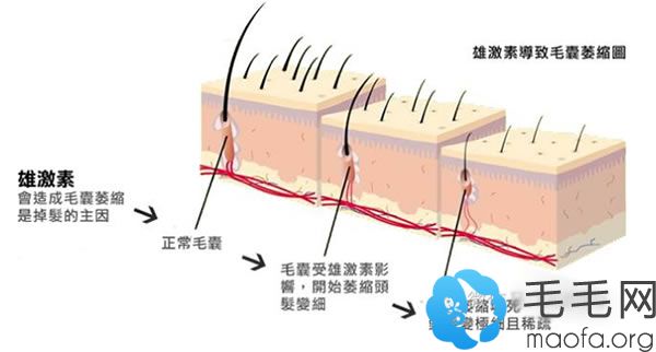 雄性激素导致毛囊萎缩示意图