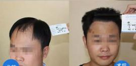 广州植发发际线+额角植发案例 移植3050单位做回型男