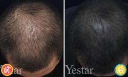 北京艺星植发男性植发案例 坚持原则植发保证完美效果