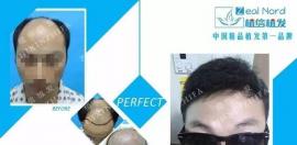 北京植信植发年末植发问题医生Q&A 总有一个能帮到你