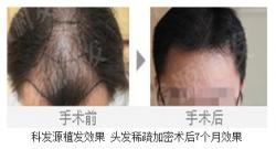 科发源植发效果 头发稀疏加密术后7个月效果