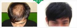 杭州杭城皮肤病研究院 头发种植案例
