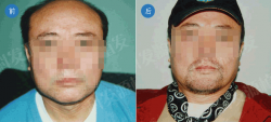 深圳科发源植发中心 胡须种植案例