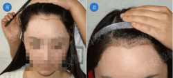 深圳科发源植发中心 美人尖案例