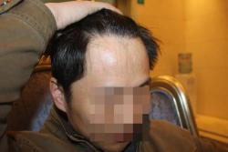 二三级植发真实案例