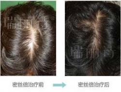 密丝倍植发案例