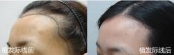 女性植发际线术后八个月效果图