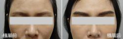 女性的自然眉型 植眉术后八个月效果