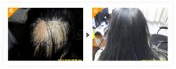 疤痕植发修复案例