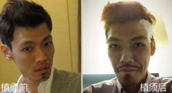 中国台湾生发诊所造就的蓄胡男 植须案例效果图